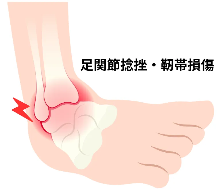 足関節捻挫のイメージ