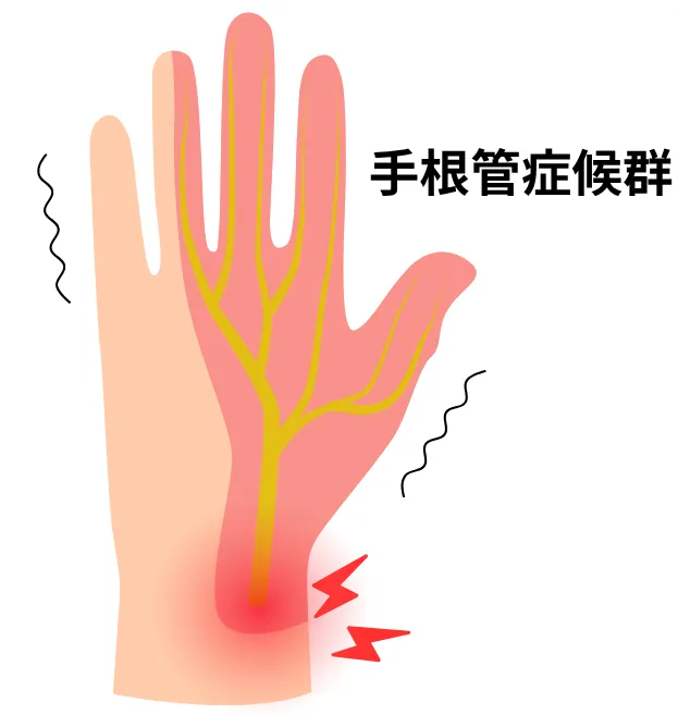 手根管症候群のイメージ