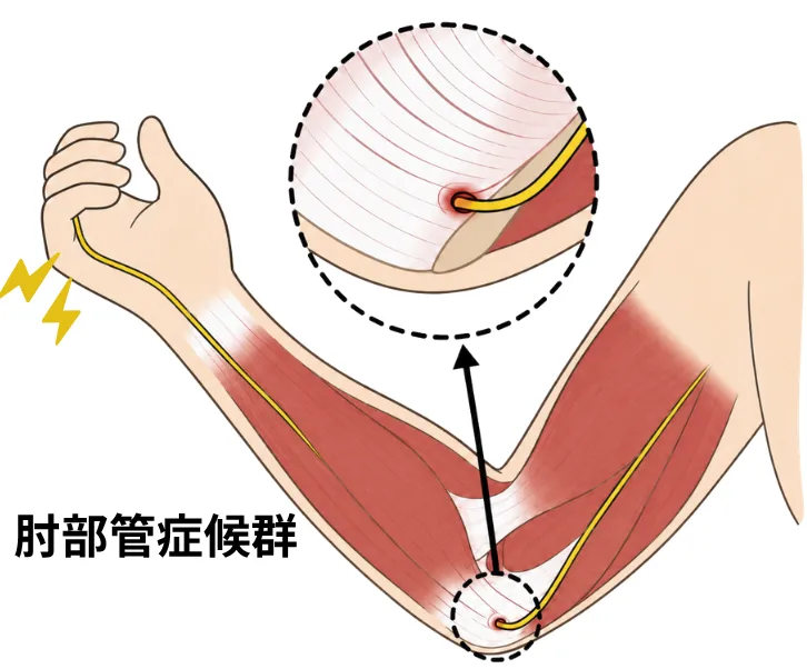 肘部管症候群のイメージ