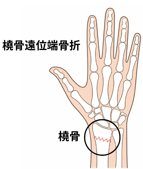 橈骨遠位端骨折のイメージ