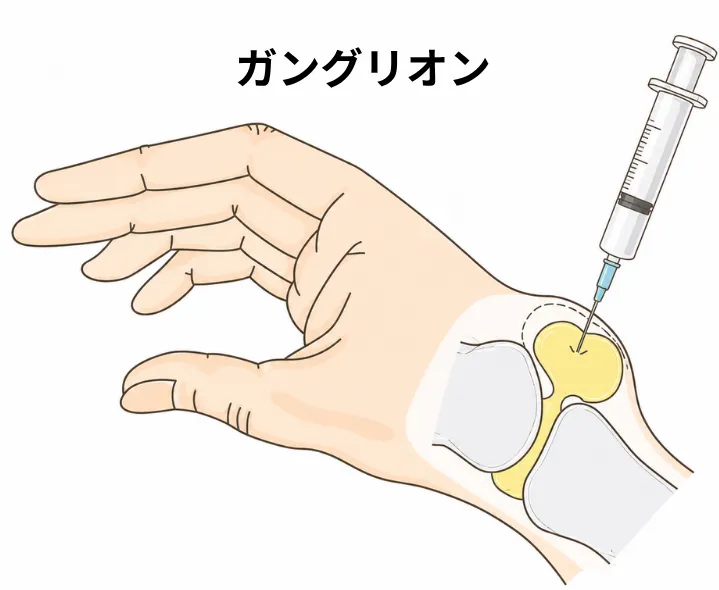 ガングリオンのイメージ