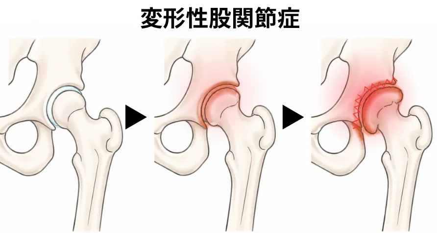 変形性股関節症のイメージ