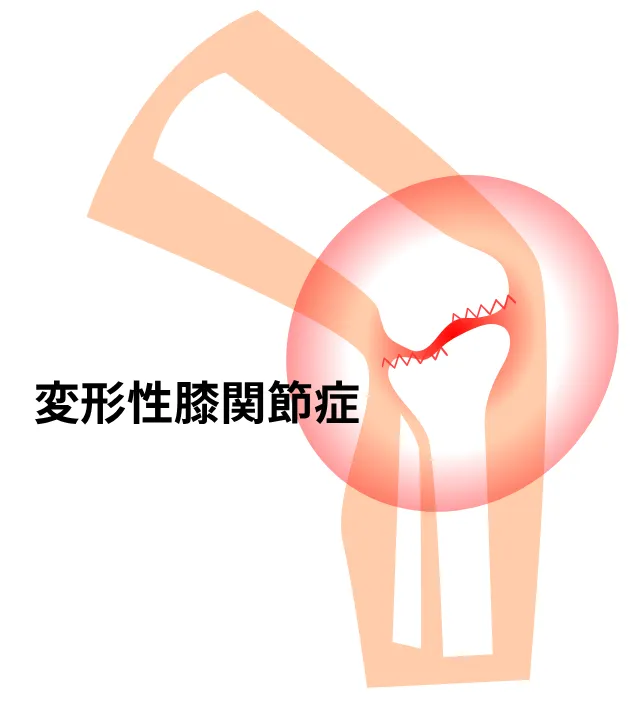 変形性膝関節症のイメージ