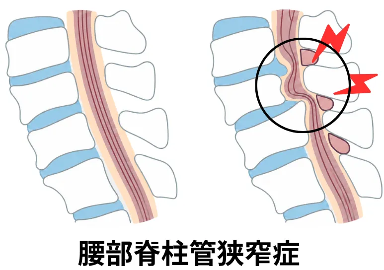 腰部脊柱管狭窄症のイメージ