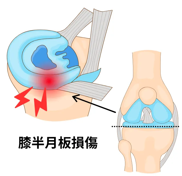 半月板損傷のイメージ