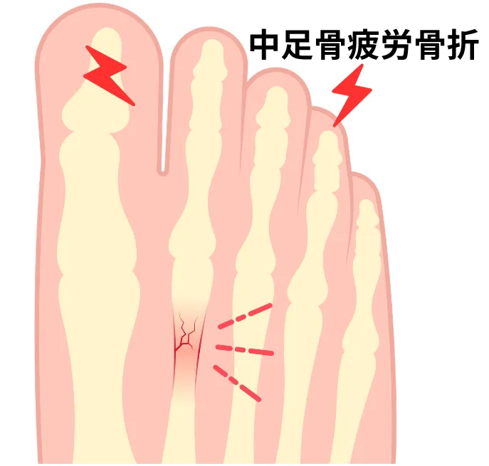 中足骨疲労骨折のイメージ