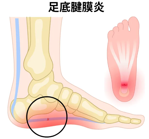 足底腱膜炎のイメージ