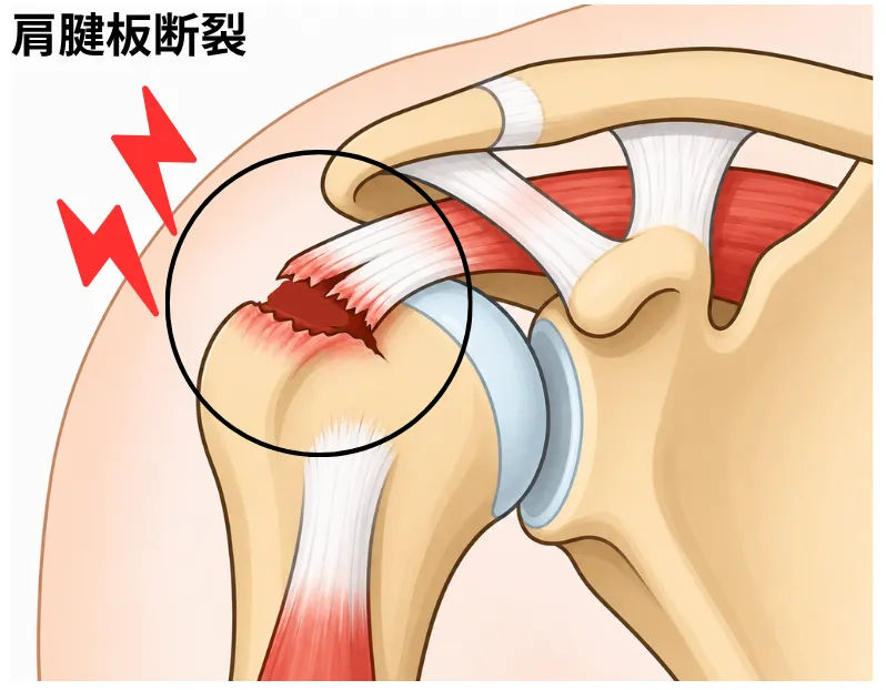 肩腱板断裂のイメージ