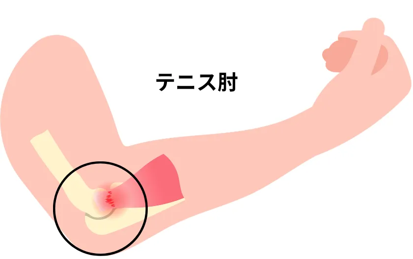 テニス肘のイメージ