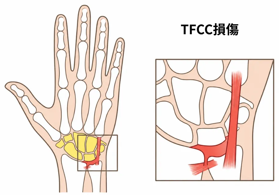 TFCC損傷のイメージ