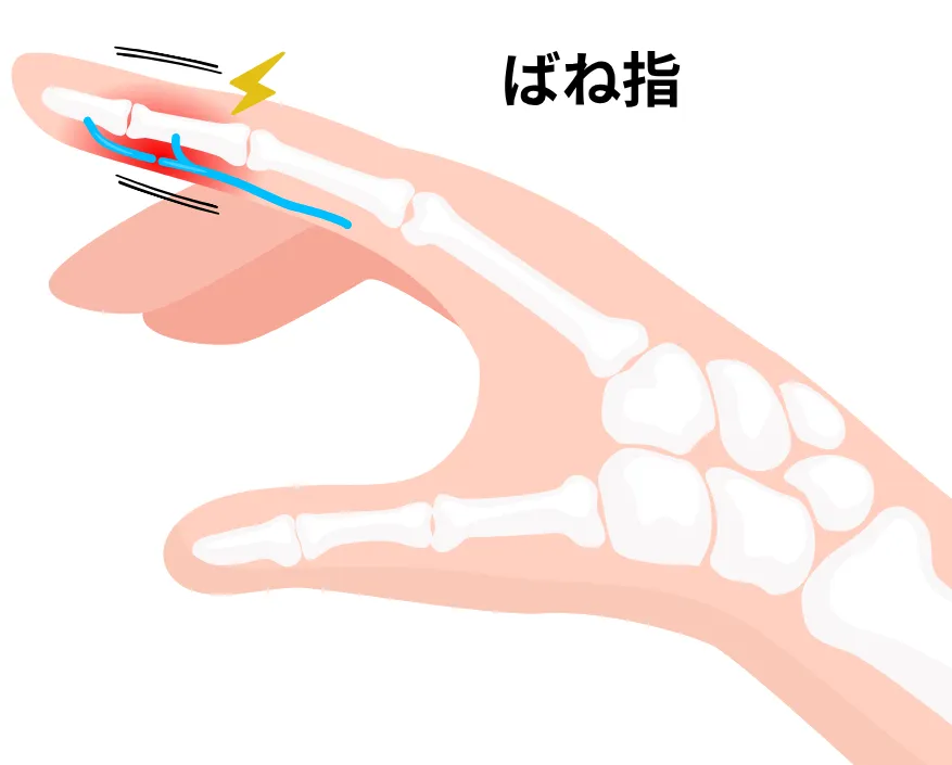 ばね指のイメージ
